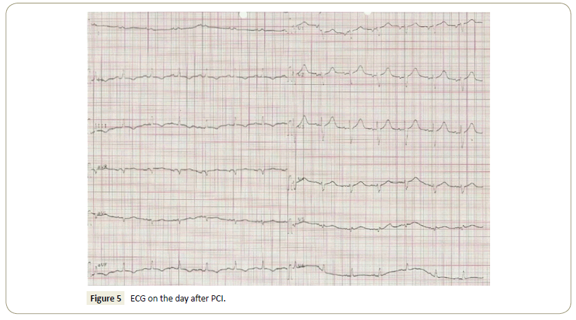 interventional-cardiology-ecg