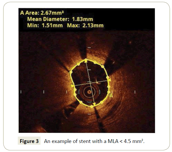 interventional-cardiology-example-stent-MLA