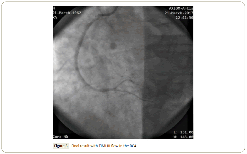 interventional-cardiology-flow