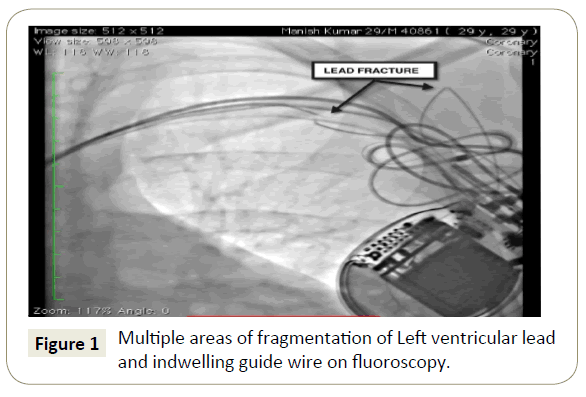 interventional-cardiology-fragmentation