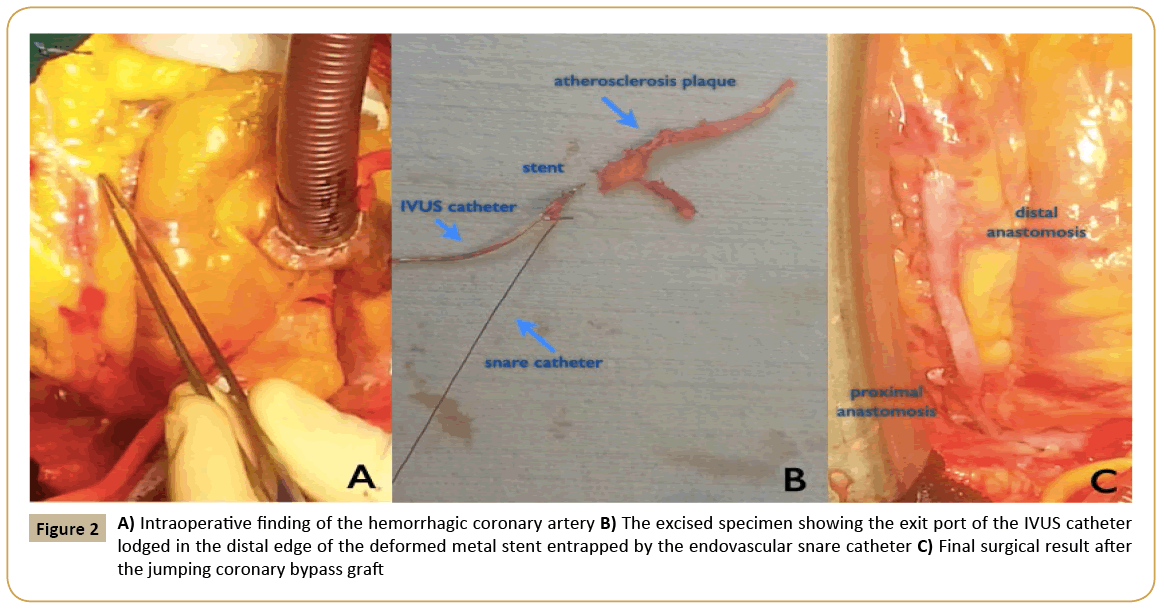 interventional-cardiology-hemorrhagic-coronary