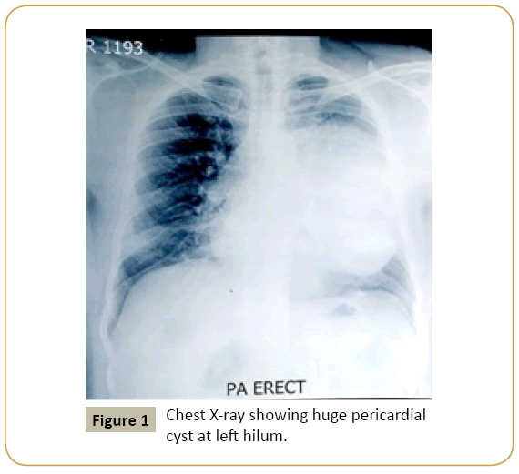 interventional-cardiology-huge-pericardial