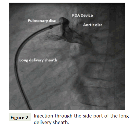 interventional-cardiology-long-delivery-sheath