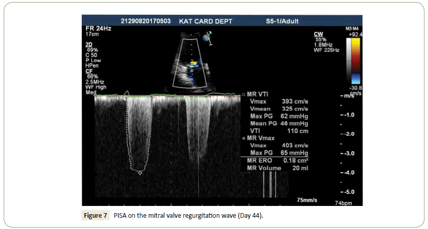 interventional-cardiology-mitral