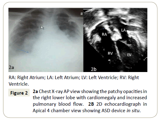 interventional-cardiology-patchy-opacities