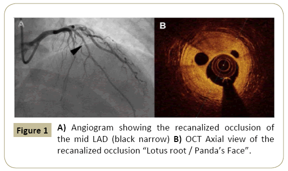 interventional-cardiology-recanalized-occlusion