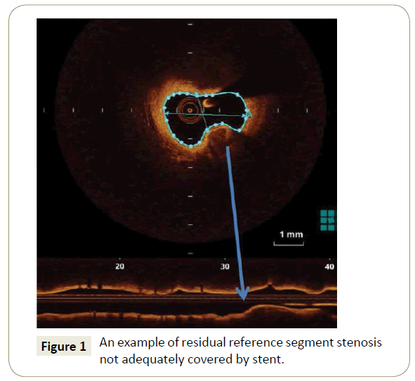 interventional-cardiology-residual-reference-segment-stenosis