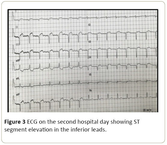 interventional-cardiology-segment-elevation