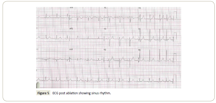 interventional-cardiology-sinus-rhythm