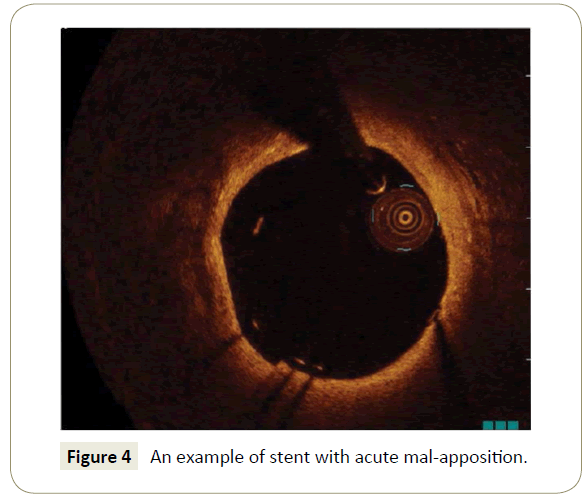 interventional-cardiology-stent-acute-mal-apposition