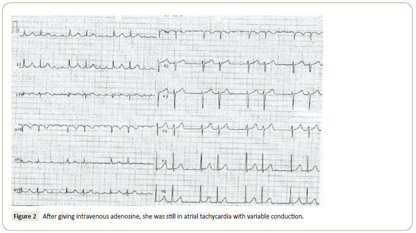 interventional-cardiology-tachycardia