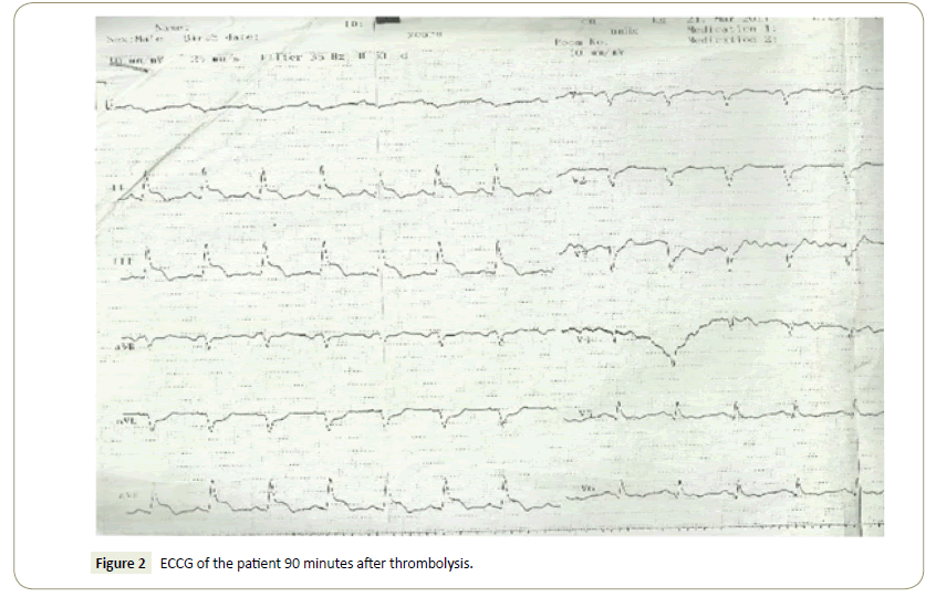 interventional-cardiology-thrombolysis