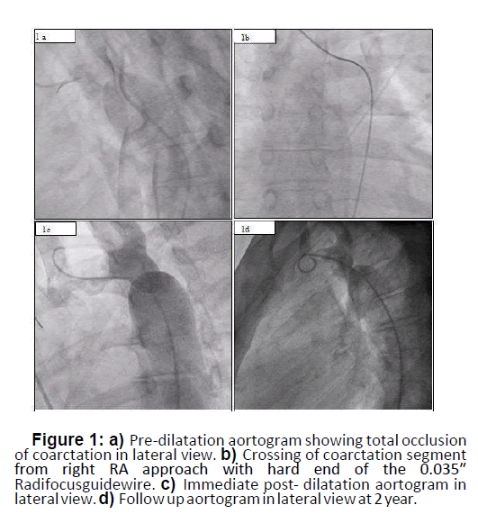 interventional-cardiology-total-occlusion