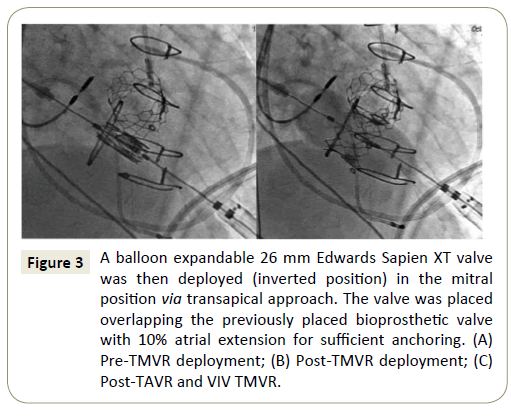 interventional-cardiology-transapical-approach
