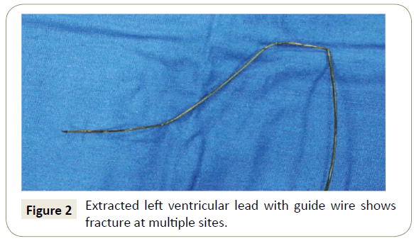 interventional-cardiology-ventricular-lead