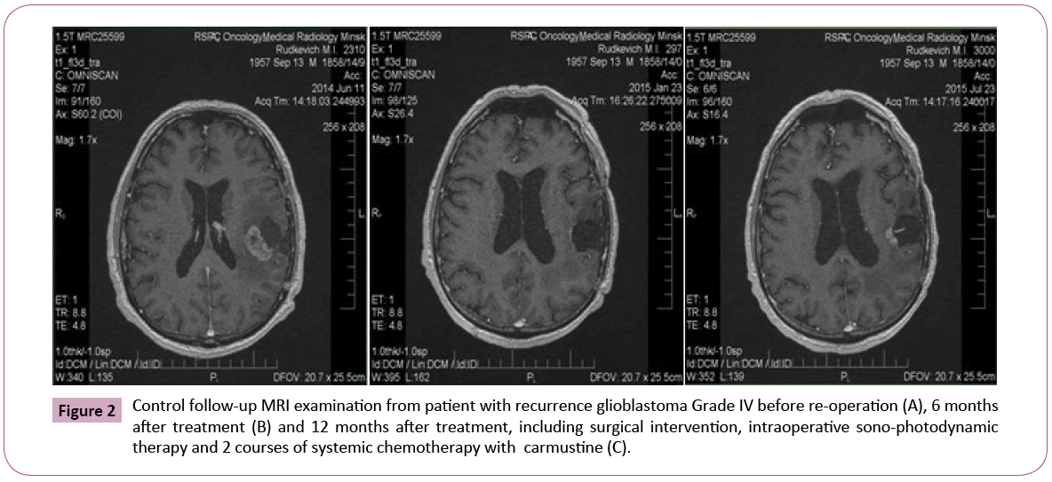 j-neurooncology-recurrence-glioblastoma