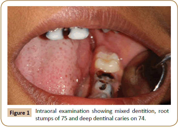 journal-oral-medicine-Intraoral-examination