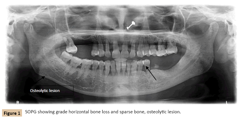 journal-oral-medicine-osteolytic