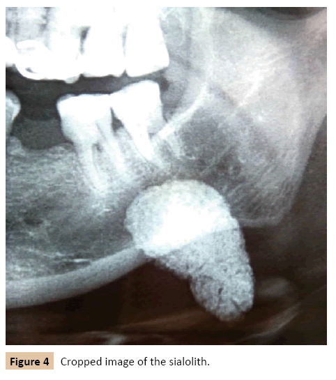 journal-oral-medicine-sialolith