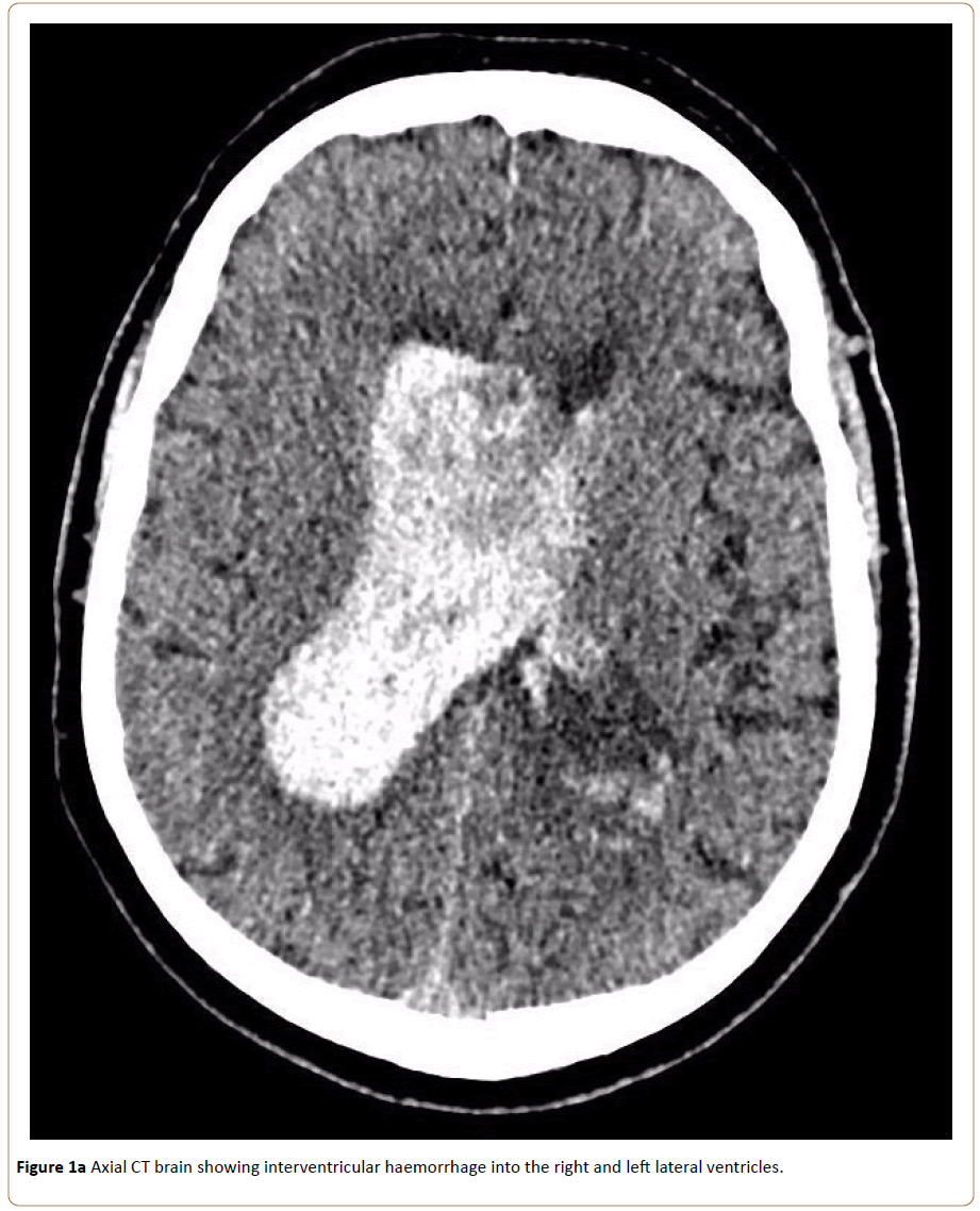 neurooncology-Axial-CT
