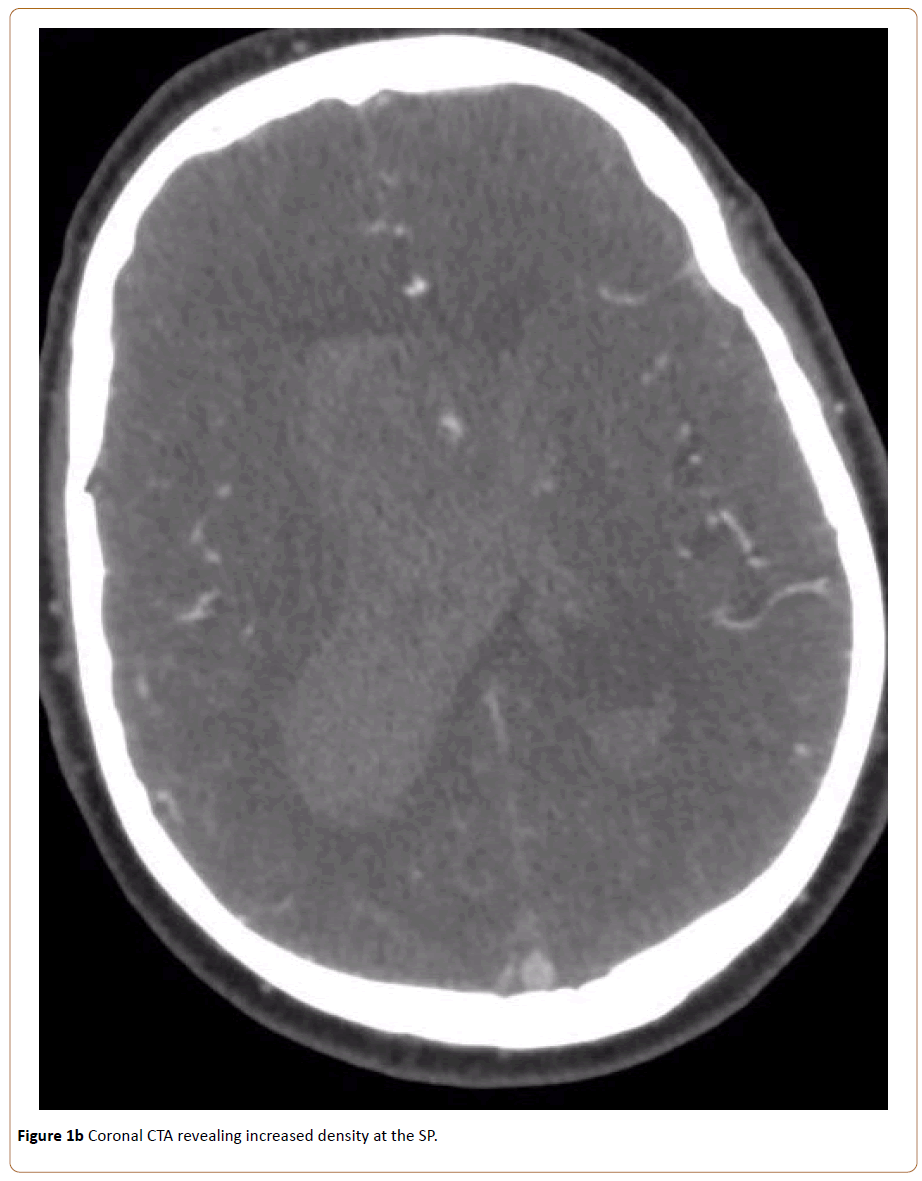 neurooncology-Coronal-CTA