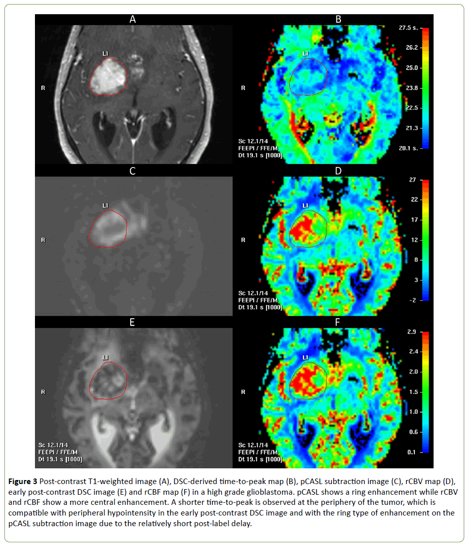 neurooncology-DSC-image