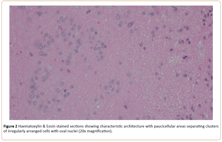 neurooncology-Eosin-stained