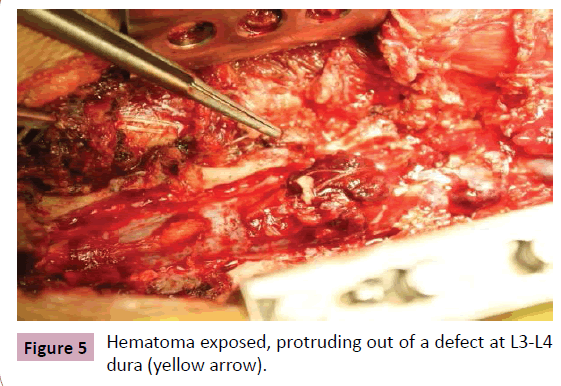 neurooncology-Hematoma-exposed