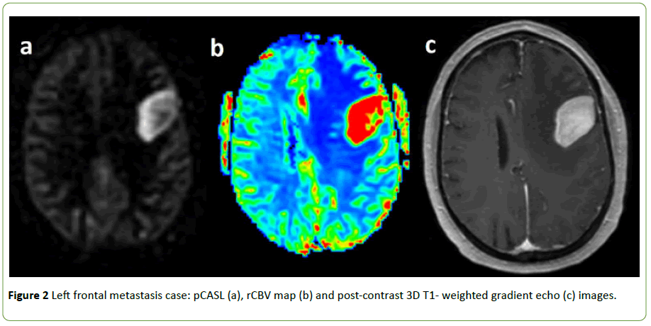 neurooncology-Left-frontal