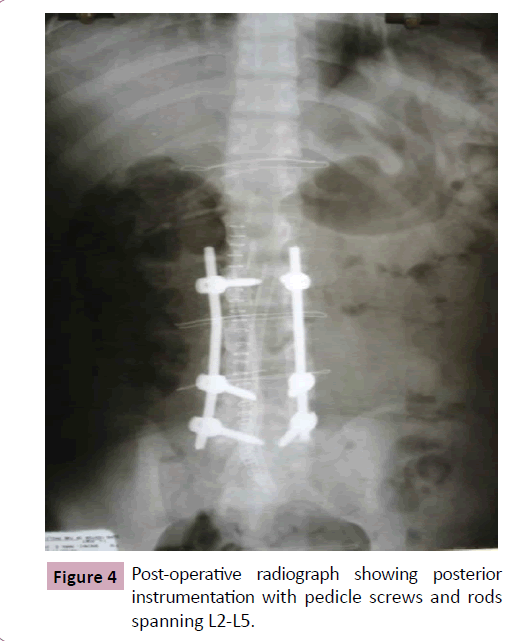 neurooncology-Post-operative-radiograph