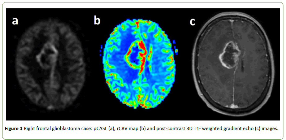 neurooncology-Right-frontal