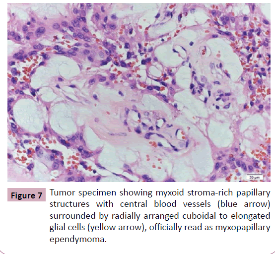 neurooncology-Tumor-specimen-showing