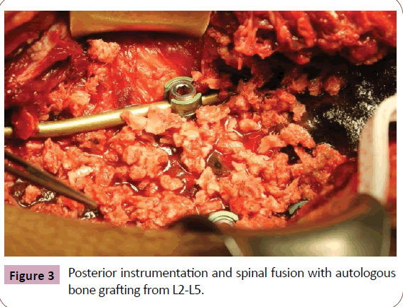 neurooncology-autologous-bone-grafting