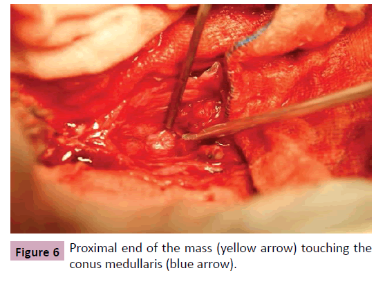 neurooncology-conus-medullaris