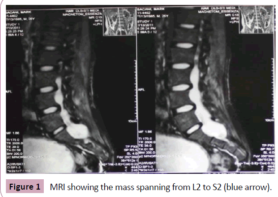 neurooncology-mass-spanning