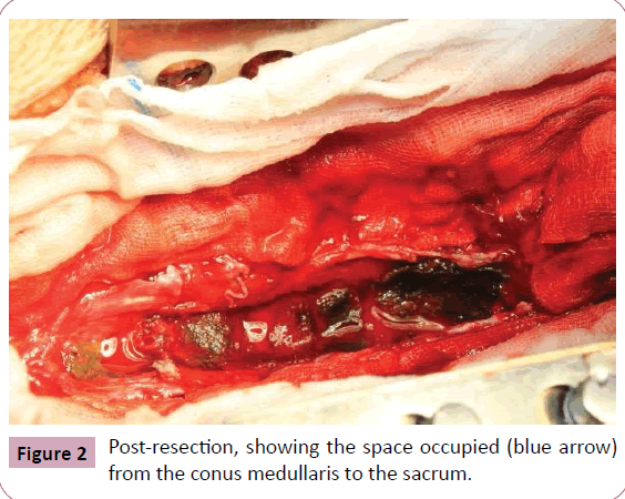 neurooncology-medullaris-sacrum