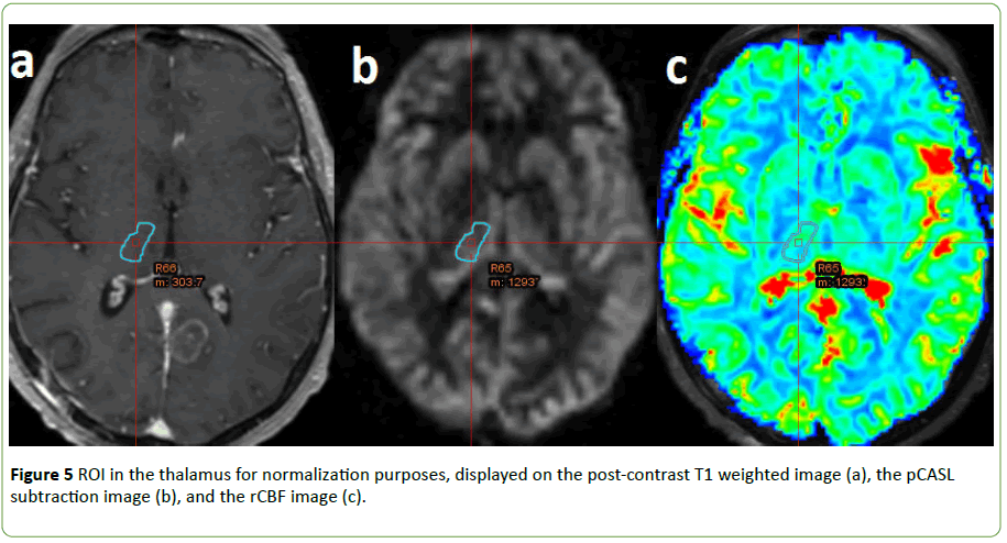 neurooncology-post-contrast