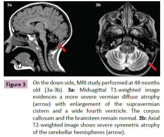 neurooncology-severe-symmetric-atrophy