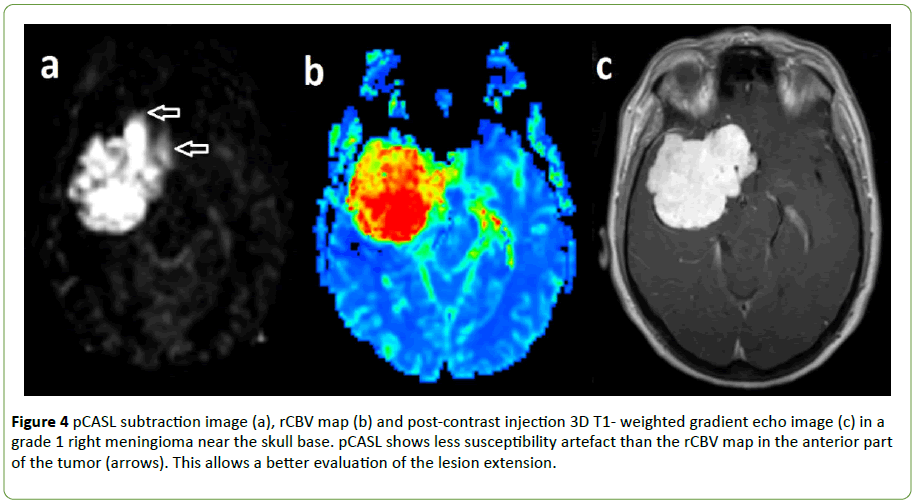 neurooncology-subtraction-image