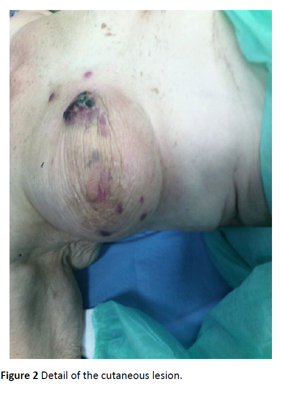 oncology-cutaneous-lesion