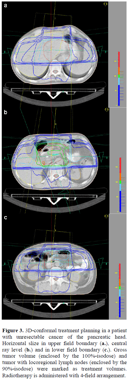 pancreas-3d-conformal-treatment