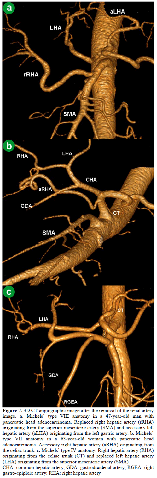 pancreas-3d-ct-angiographic-image-renal-artery