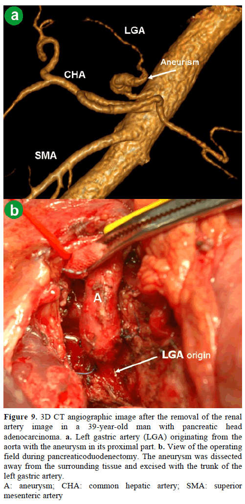 pancreas-3d-ct-left-gastric-artery-aneurysm