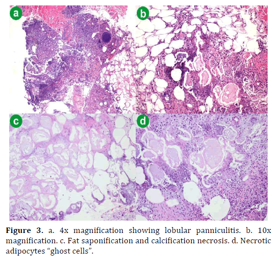 pancreas-4x-magnification-panniculitis