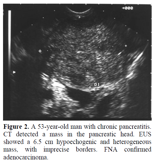 pancreas-53-year-old-man-chronic-pancreatitis