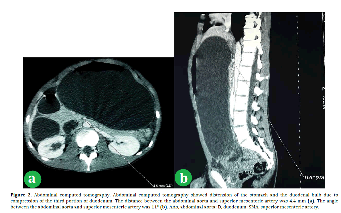 pancreas-Abdominal-computed