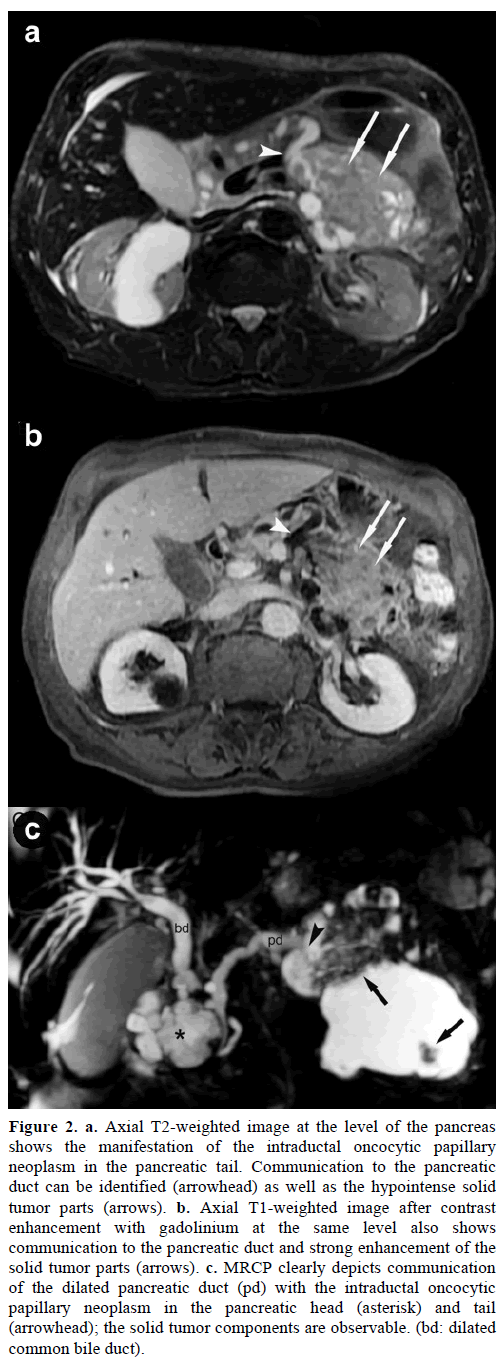 pancreas-Axial-t2-weighted-image-level