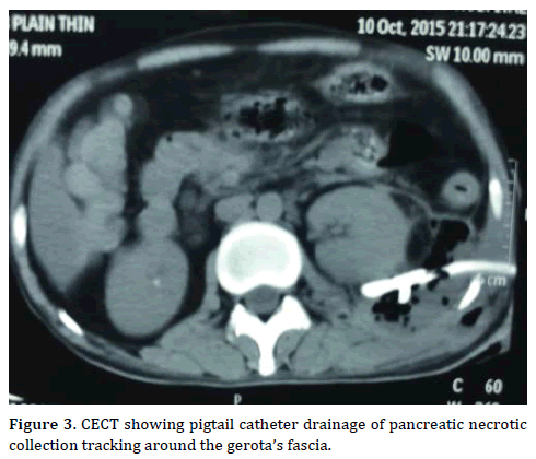 pancreas-CECT-showing-pigtail-catheter