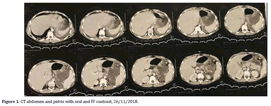 pancreas-CT-abdomen