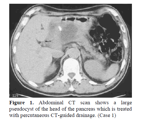 pancreas-CT-guided-drainage